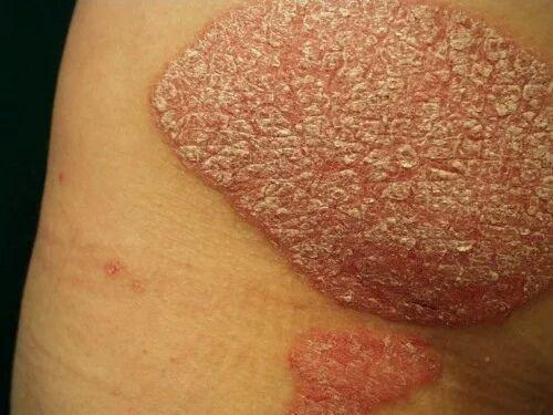 牛皮癣患者要重视生活中的各项护理