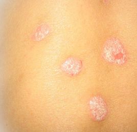 牛皮癣患者应了解的注意事项有哪些-患者可以哺乳吗